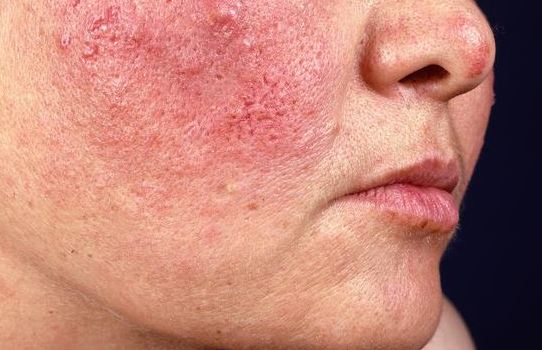 Rosazea verstehen – und die Haut auf natürliche Weise unterstützen